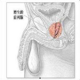 前列腺增生手术视频,技术要点与术后康复指导